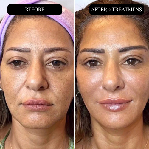 Dermique® Skin-Regenerating Micro-Infusion