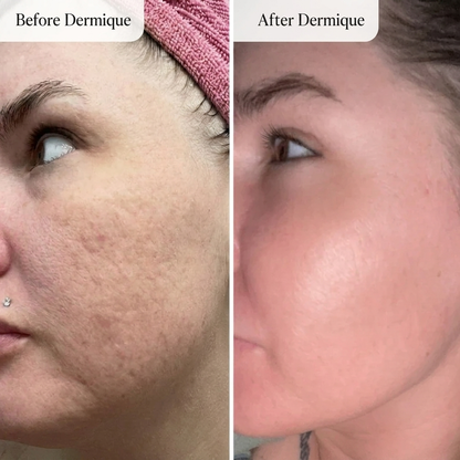 Dermique Micro-Infusion System®
