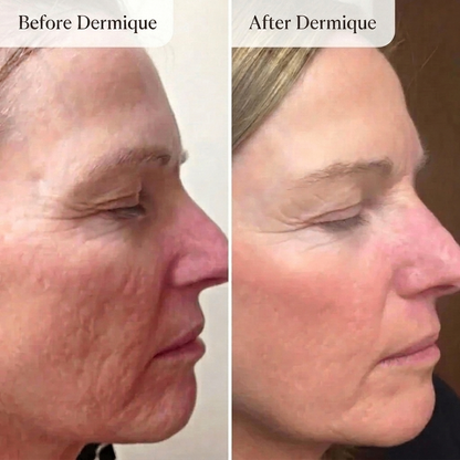 Dermique Micro-Infusion System®